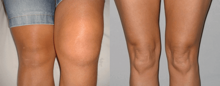 Izkušnje z uporabo kapsul konopljinega olja pred in po uporabi od Eve